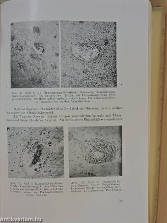 Die neuroallergischen Beziehungen in der Histopathologie der Multiplen Sklerose