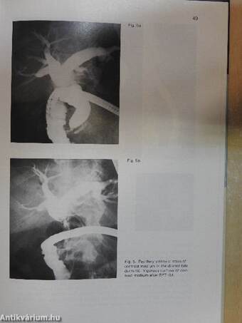 Endoscopic Sphincterotomy of the Papilla of Vater