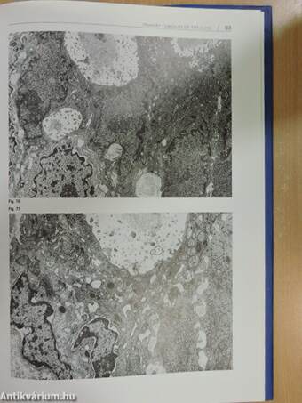 Ultrastructural aspects of human lung diseases