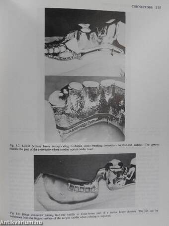 Designing Partial Dentures