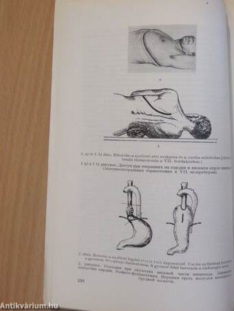 Radikális transthoracalis műtétek nyelőcső és cardiaráknál