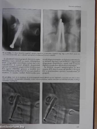 Craniospinalis instabilitás