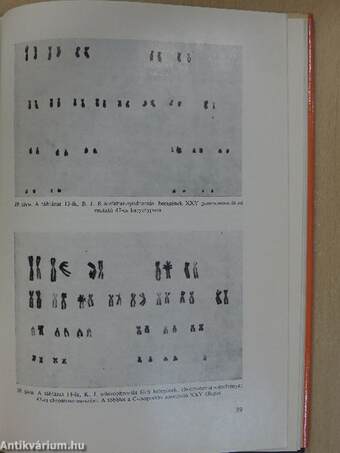 A nemi chromosoma-aberrációk idegrendszeri vonatkozásai (dedikált példány)