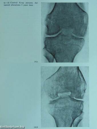 Radiology of Haemophilic Arthropathies