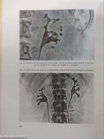 Pyelonephritis