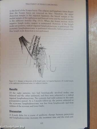 Lymph Node Surgery in Urology