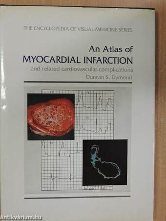 An Atlas of Myocardial Infarction and related cardiovascular complications