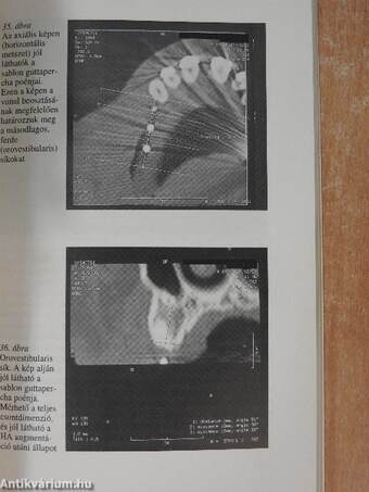 Fogászati implantológia