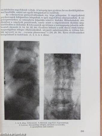 Alkaptonuria és ochronosis