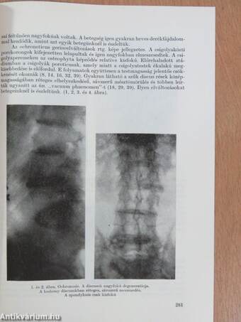 Alkaptonuria és ochronosis