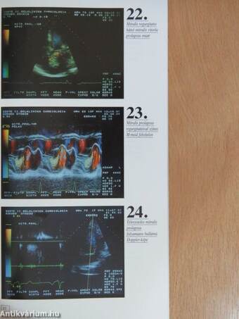 A színkódolt doppler echocardiographia atlasza