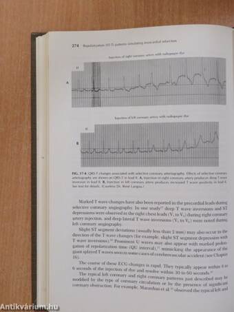 Myocardial Infarction