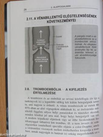 Tromboembólia: a megelőzhető sorscsapás