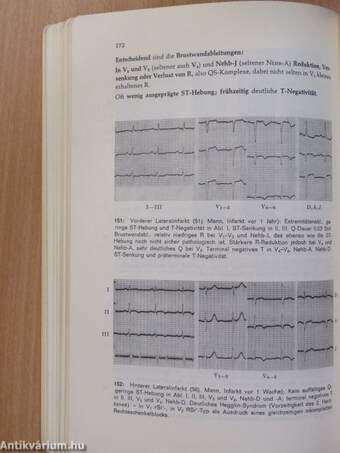 Ekg-Fibel