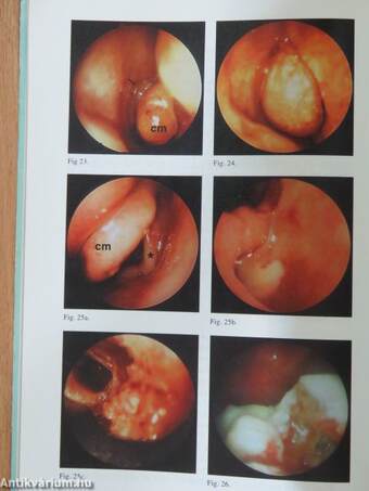 Functional Endoscopic Sinus Surgery