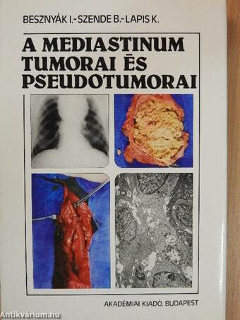 A mediastinum tumorai és pseudotumorai