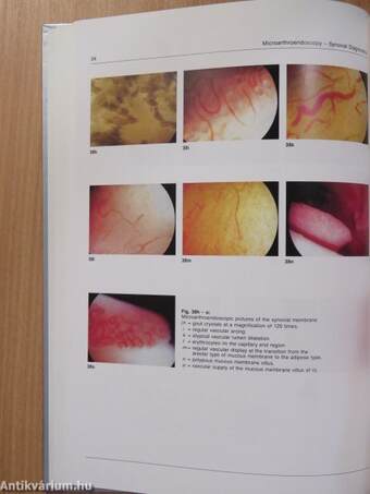 Microarthroendoscopy