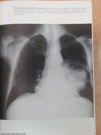 Thoracic Pathology Illustrated