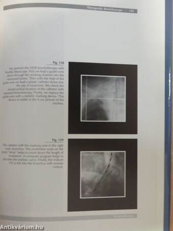 Bronchoscopic Aspects of Human Lung Diseases