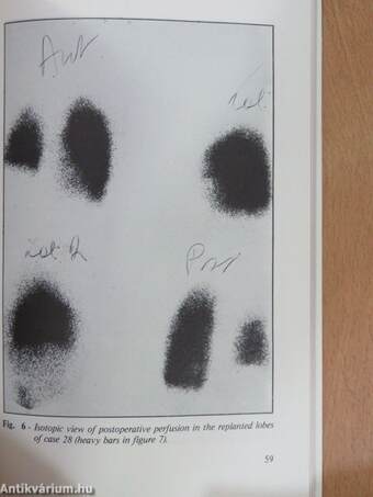 Cancer of the lung and pleura