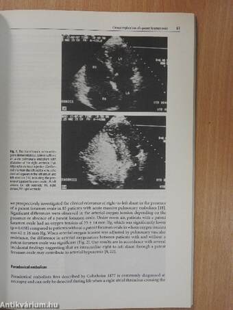 Acute Pulmonary Embolism