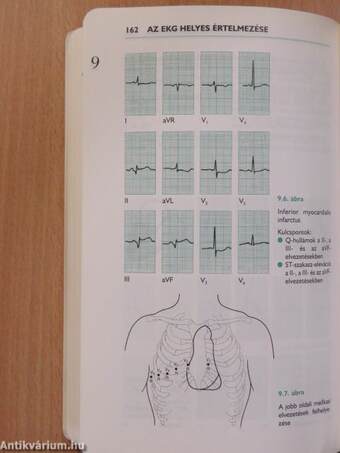 Az EKG helyes értelmezése