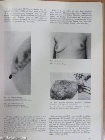 Atlas of the Diseases of the Mammary Gland/Atlas der Brustdrüsen-erkrankungen