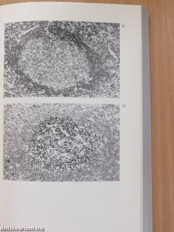 Non-Hodgkin lymphoma (dedikált példány)