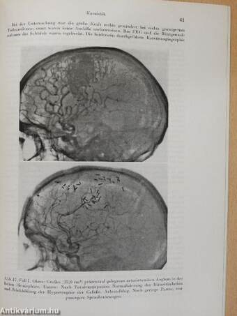 Die Totalexstirpation intrazerebraler arteriovenöser Angiome bei Lokalisation in funktionell wichtigen Hirnarealen