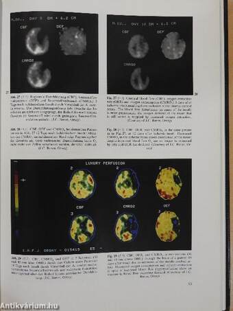 Atlas der Positronen-Emissions-Tomographie des Gehirns/Atlas of Positron Emission Tomography of the Brain