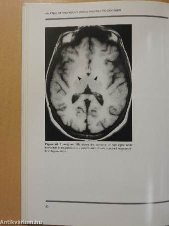 An Atlas of Parkinson's Disease and Related Disorders