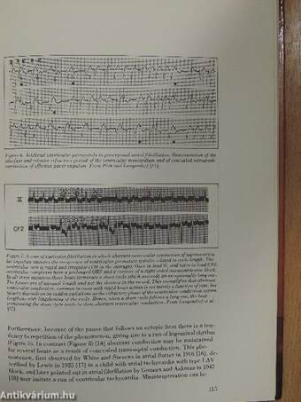 Atrial Fibrillation