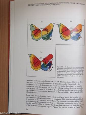 Atrial Fibrillation