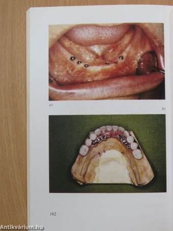 Fogászati implantológia