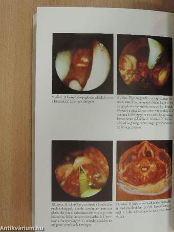 A nehéz intubálás avagy a nehezen biztosítható szabad légút