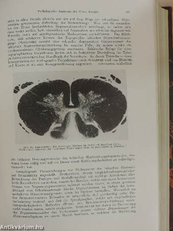 Syphilis des Nervensystems