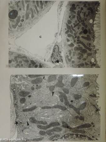 A heveny bacterialis pyelonephritis pathomorphologiája