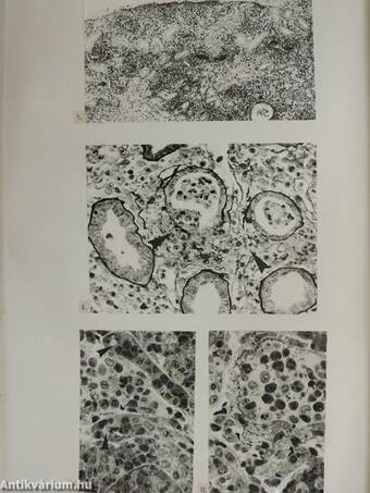 A heveny bacterialis pyelonephritis pathomorphologiája