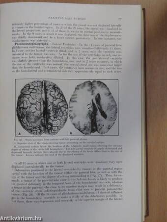 The Abnormal Pneumoencephalogram