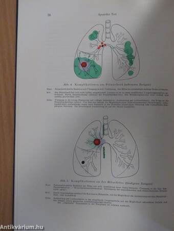 Die Lungentuberkulose im Röntgenbild