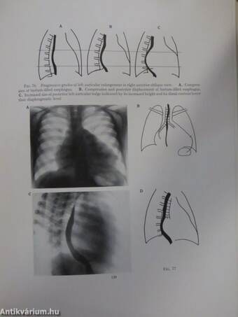 Clinical Roentgenology of the Heart