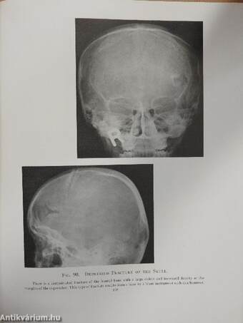 Roentgen Diagnosis of Diseases of the Skull