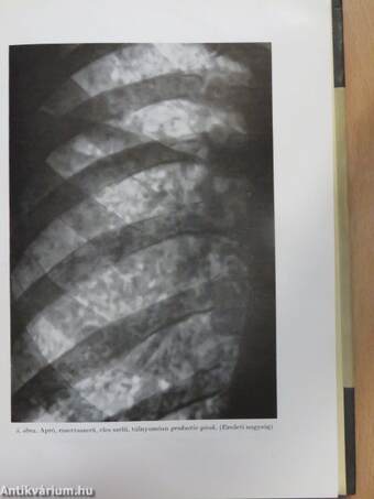 A tüdőgümőkór röntgenképe és elkülönítő kórisméje