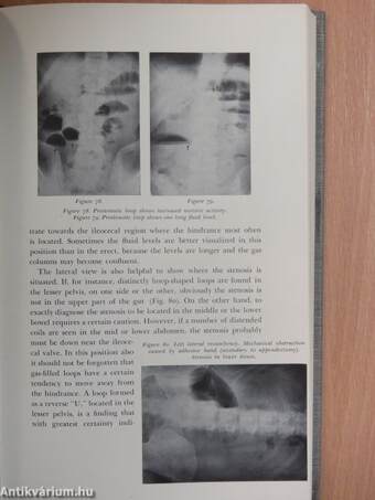 Roentgen Examinations In Acute Abdominal Diseases