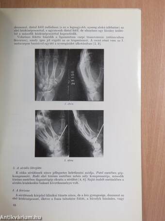 Izolált, törés nélküli trapesium-ficam