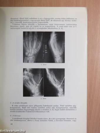 Izolált, törés nélküli trapesium-ficam