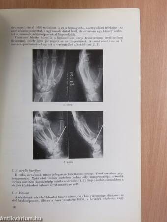 Izolált, törés nélküli trapesium-ficam