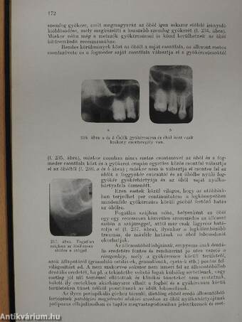 A száj és az állcsontok dentális betegségeinek sebészete