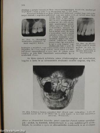 A száj és az állcsontok dentális betegségeinek sebészete