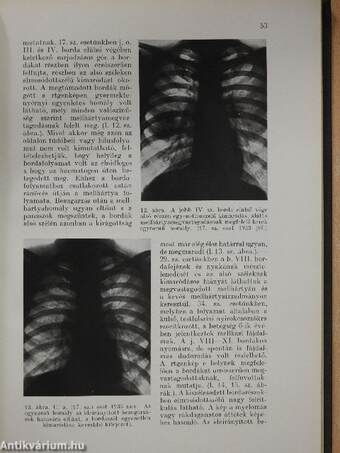 A lymphogranulomatosis kór- és gyógytana